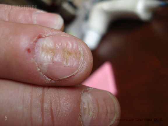 Дистрофические изменения ногтей: что за проблема и как с ней бороться